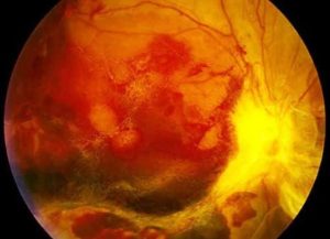 advanced-diabatic-retinopathy