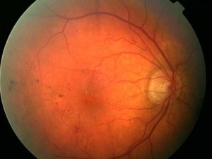 early-diabatic-retinopathy