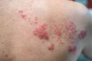 skin diseases